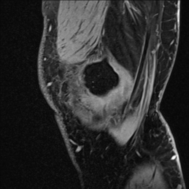 Anterior cruciate ligament tear - ramp lesion (Radiopaedia 71883-82322 Sagittal T1 vibe 124).jpg