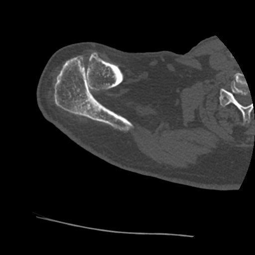 Anterior glenohumeral dislocation with Hill-Sachs lesion (Radiopaedia 62877-71249 Axial bone window 12).jpg
