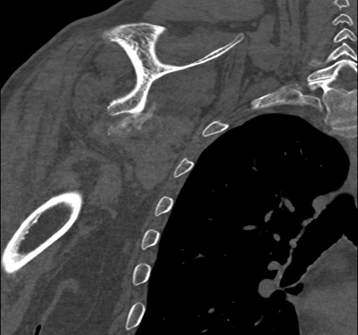 Anterior glenohumeral dislocation with Hill-Sachs lesion (Radiopaedia 62877-71249 Coronal bone window 71).jpg