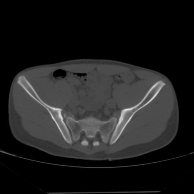 Anterior inferior iliac spine avulsion fracture (Radiopaedia 49469-54627 Axial bone window 17).jpg