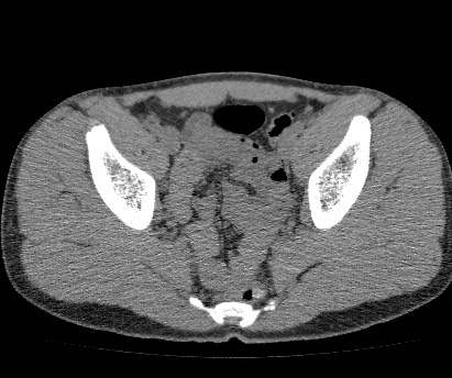 Anterior inferior iliac spine avulsion fracture (Radiopaedia 81312-94999 Axial non-contrast 44).jpg