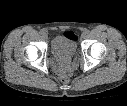 Anterior inferior iliac spine avulsion fracture (Radiopaedia 81312-94999 Axial non-contrast 53).jpg