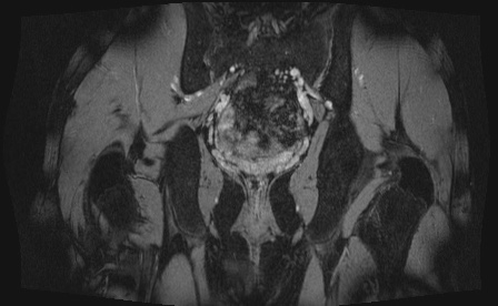 Anterior inferior iliac spine avulsion fracture (Radiopaedia 81312-95000 G 7).jpg