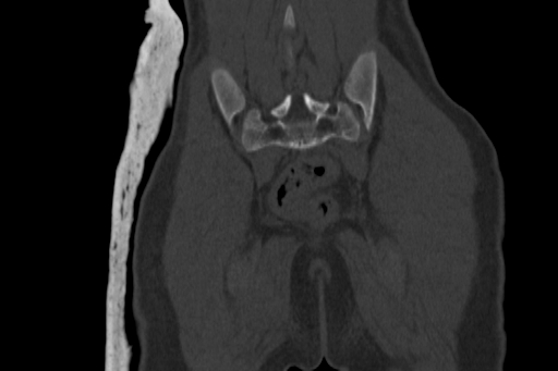 Anterior inferior iliac spine avulsion injury (Radiopaedia 88666-105376 Coronal bone window 59).jpg