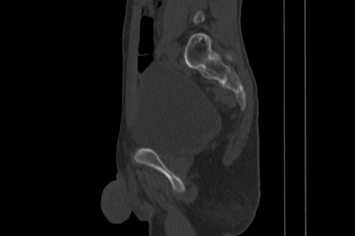 Anterior inferior iliac spine avulsion injury (Radiopaedia 88666-105376 Sagittal bone window 60).jpg