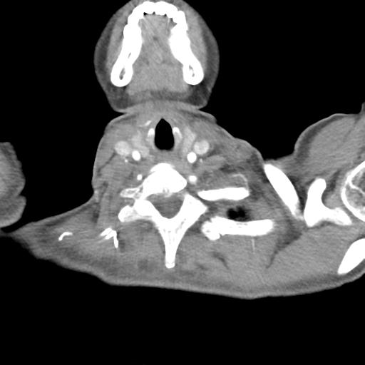 Anterior mediastinal lymphoma (Radiopaedia 29556-30061 C 2).jpg