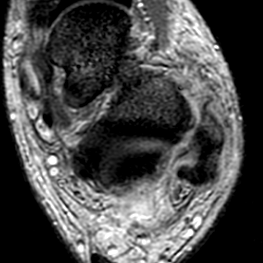 File:Anterior talofibular ligament rupture (Radiopaedia 15831-15484 Axial T2* 13).jpg