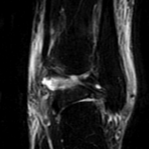 File:Anterior talofibular ligament rupture (Radiopaedia 15831-15484 Coronal STIR 16).jpg