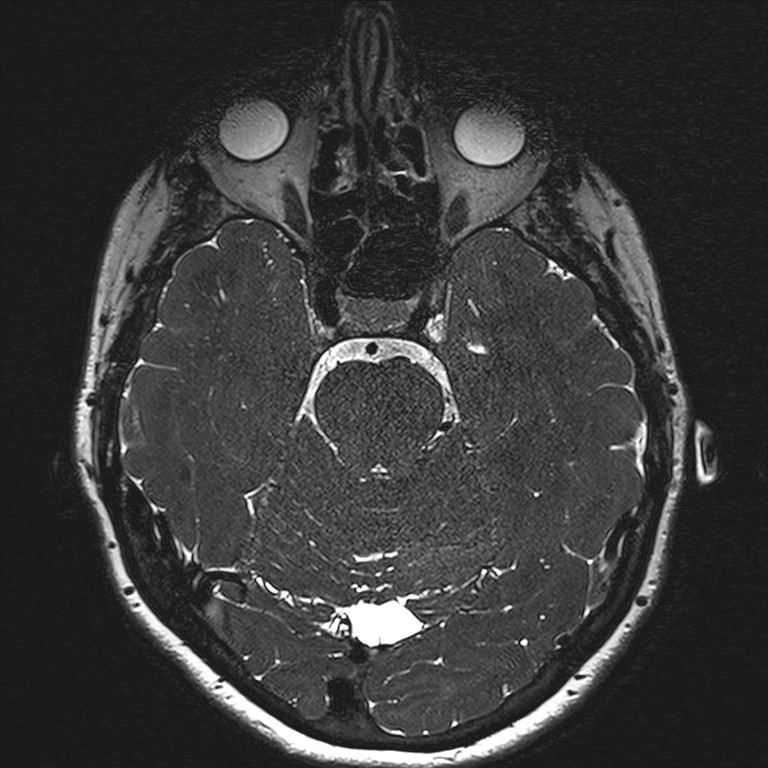Anterior temporal encephalocele (Radiopaedia 82624-96808 Axial T2 high res 60).jpg
