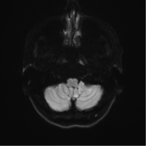 Anterior temporal lobe perivascular space (Radiopaedia 40946-43650 Axial DWI 30).png