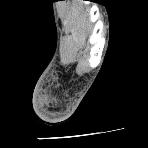 Anterior tibial artery false aneurysm (Radiopaedia 88984-105809 A 237).jpg