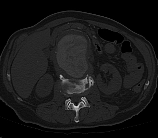 File:Anterior vertebral scalloping (abdominal aortic aneurysm) (Radiopaedia 66744-76067 Axial bone window 11).jpg