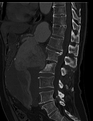 File:Anterior vertebral scalloping (abdominal aortic aneurysm) (Radiopaedia 66744-76067 Sagittal bone window 34).jpg