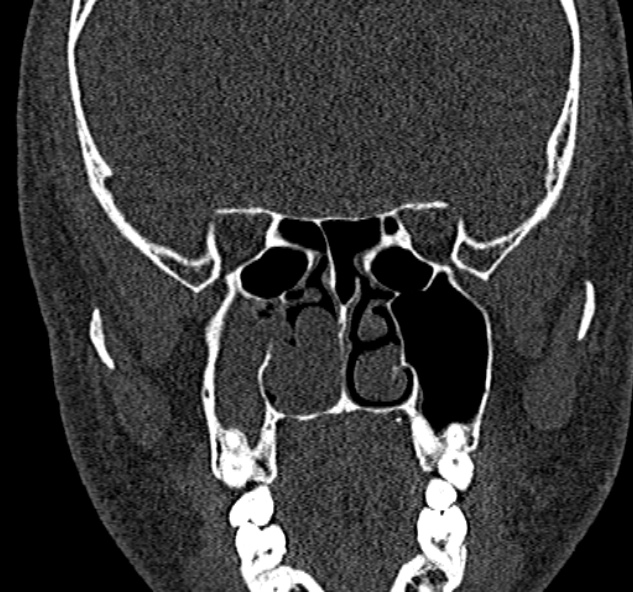 Antrochoanal polyp (Radiopaedia 30002-30554 Coronal bone window 48).jpg
