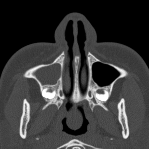 Antrochoanal polyp (Radiopaedia 33984-35202 Axial bone window 12).jpg