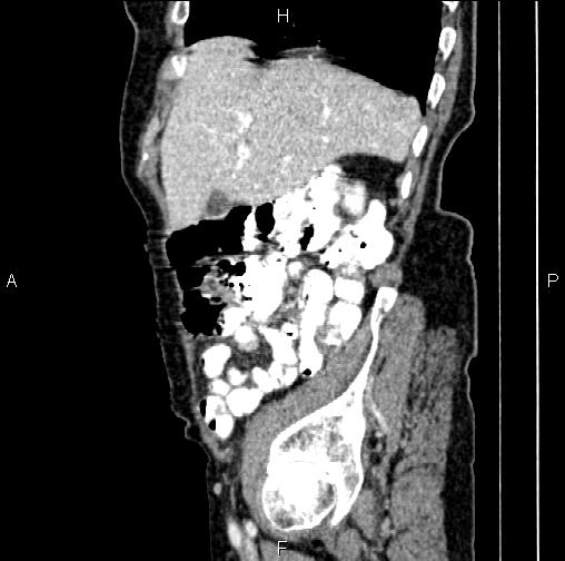 Aortic aneurysm and Lemmel syndrome (Radiopaedia 86499-102554 D 18).jpg