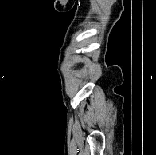 Aortic aneurysm and Lemmel syndrome (Radiopaedia 86499-102554 D 88).jpg