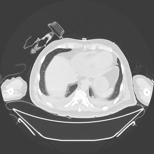 Aortic arch aneurysm (Radiopaedia 84109-99365 Axial lung window 225).jpg