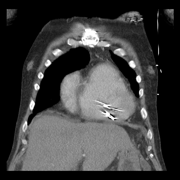 Aortic arch graft infection (FDG PET-CT) (Radiopaedia 71975-82437 Coronal 17).jpg