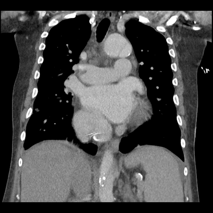 Aortic arch graft infection (FDG PET-CT) (Radiopaedia 71975-82437 Coronal 33).jpg