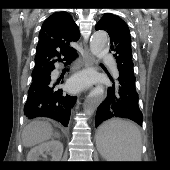 Aortic arch graft infection (FDG PET-CT) (Radiopaedia 71975-82437 Coronal 41).jpg