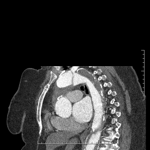 File:Aortic dissection- Stanford A (Radiopaedia 35729-37268 D 22).jpg