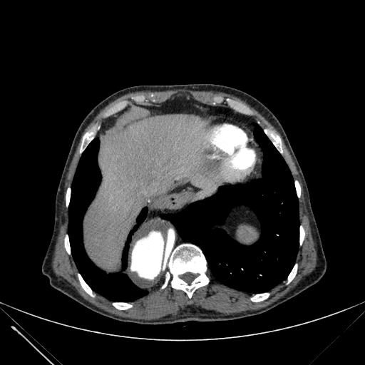 Aortic dissection (Radiopaedia 27466-27665 C+ arterial phase 240).jpg