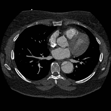 Aortic dissection (Radiopaedia 57969-64959 A 178).jpg