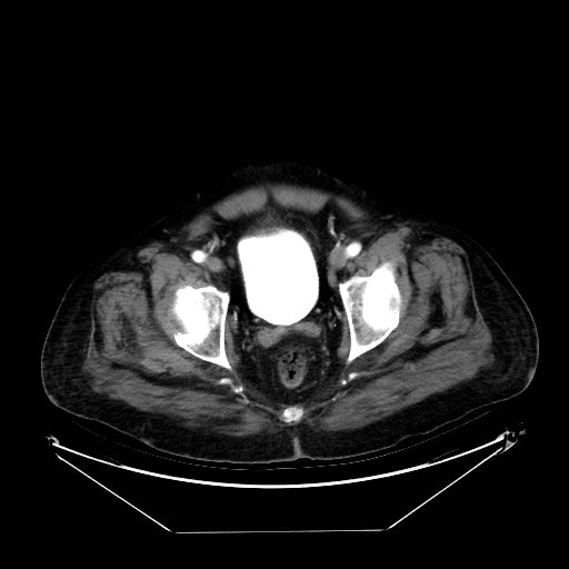 Aortic dissection (Radiopaedia 62562-71000 A 104).jpg