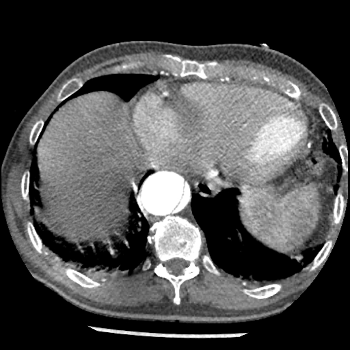 Aortic dissection - DeBakey Type I-Stanford A (Radiopaedia 79863-93115 A 31).jpg