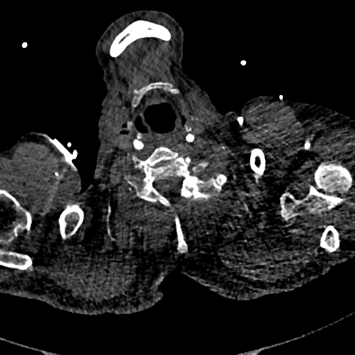 File:Aortic dissection - DeBakey type II (Radiopaedia 64302-73082 A 1).png