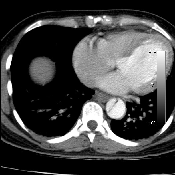 Aortic dissection - Stanford type A (Radiopaedia 29247-29659 A 54).jpg