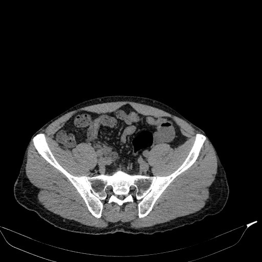 Aortic dissection - Stanford type A (Radiopaedia 83418-98500 Axial non-contrast 76).jpg