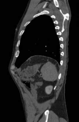 File:Aortic dissection - Stanford type B (Radiopaedia 73648-84437 C 22).jpg