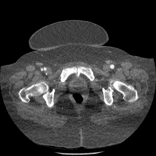 Aortic dissection - Stanford type B (Radiopaedia 88281-104910 A 161).jpg