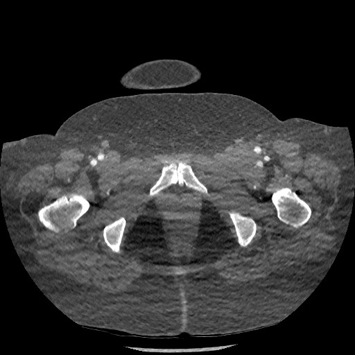Aortic dissection - Stanford type B (Radiopaedia 88281-104910 A 165).jpg