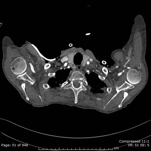 File:Aortic dissection with extension into aortic arch branches (Radiopaedia 64402-73204 B 51).jpg