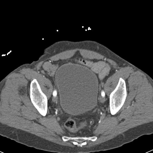 File:Aortic intramural hematoma (Radiopaedia 31139-31838 B 152).jpg