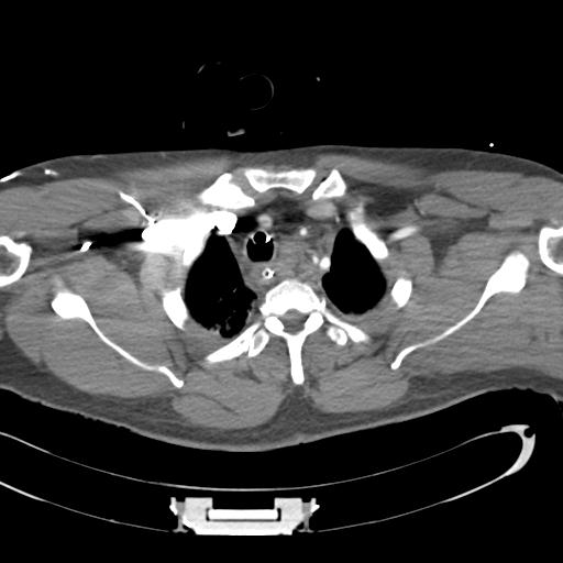 Aortic transection, diaphragmatic rupture and hemoperitoneum in a complex multitrauma patient (Radiopaedia 31701-32622 A 16).jpg