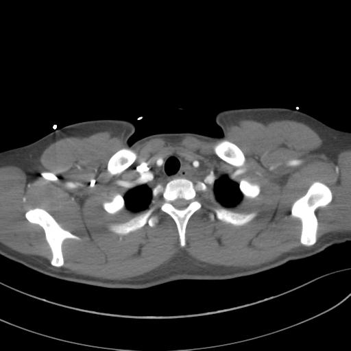 File:Aortic transection (Radiopaedia 29890-30405 A 14).jpg