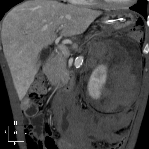 Aorto-left renal vein fistula (Radiopaedia 45534-49628 B 17).jpg