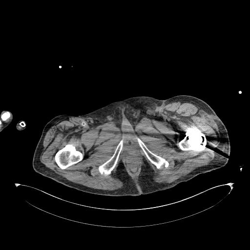 Aortoduodenal fistula (Radiopaedia 75286-86415 Axial non-contrast 84).jpg