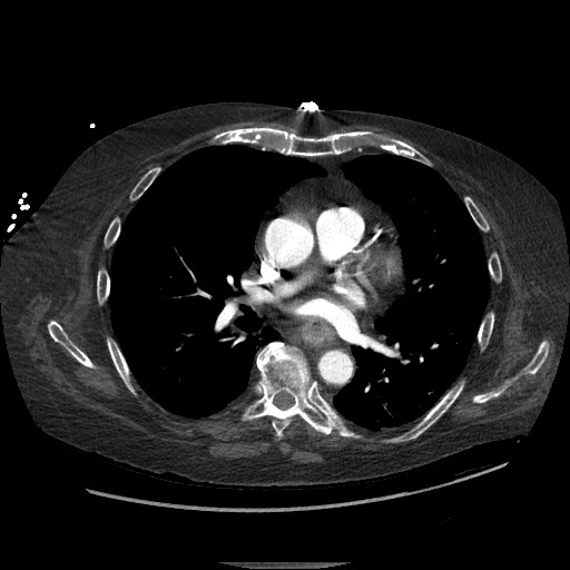 Aortoesophageal fistula with endovascular repair (Radiopaedia 73781-84592 Axial C+ CTPA 80).jpg