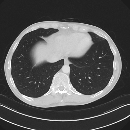 Apical pleural calcification (Radiopaedia 46141-50499 Axial lung window 56).png