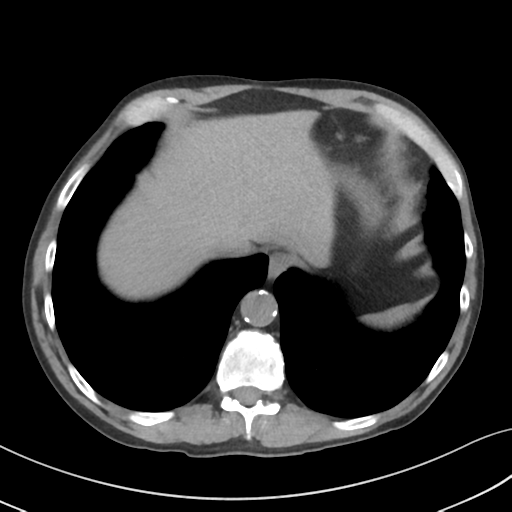 Apical pulmonary metastasis (Radiopaedia 46338-50754 B 53).png
