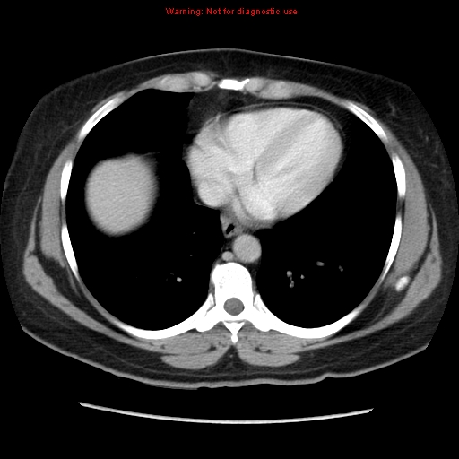 File:Appendiceal mucinous cystadenoma (Radiopaedia 8263-9111 Axial liver window 11).jpg