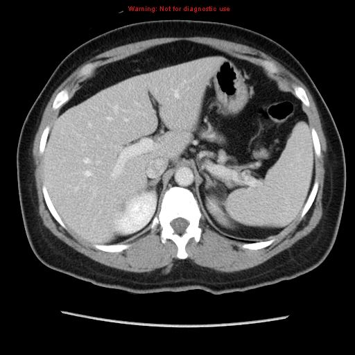 Appendiceal mucinous cystadenoma (Radiopaedia 8263-9111 Axial liver window 24).jpg
