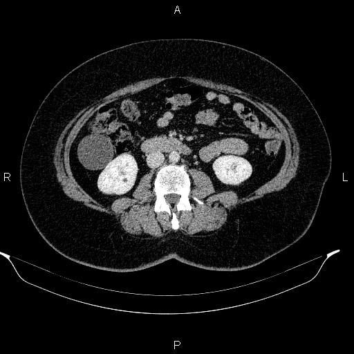 Appendiceal mucocele (Radiopaedia 83280-97688 Axial With contrast 55).jpg