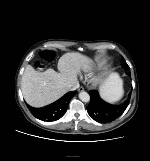 Appendicitis with localized perforation and abscess formation (Radiopaedia 49035-54130 A 18).jpg
