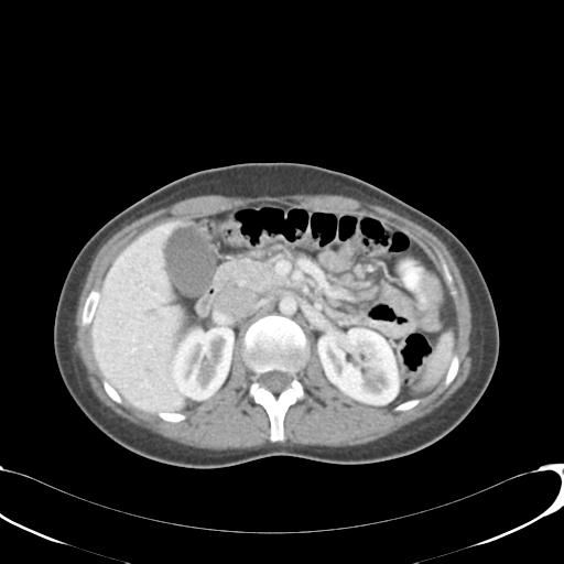 File:Appendicitis with minimal stranding but appendicolith (Radiopaedia 29035-29397 A 30).jpg
